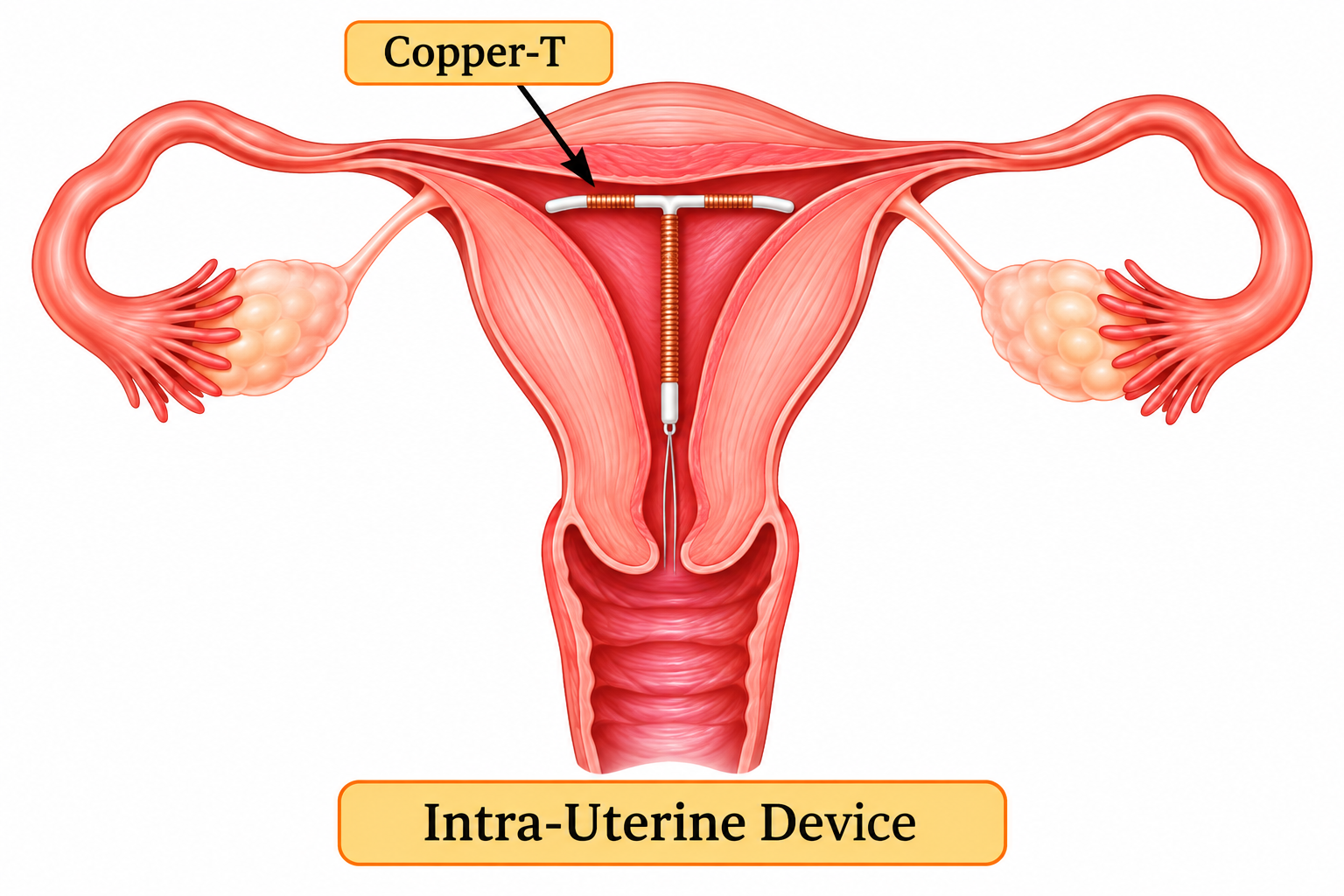 Copper-T Intrauterine Device